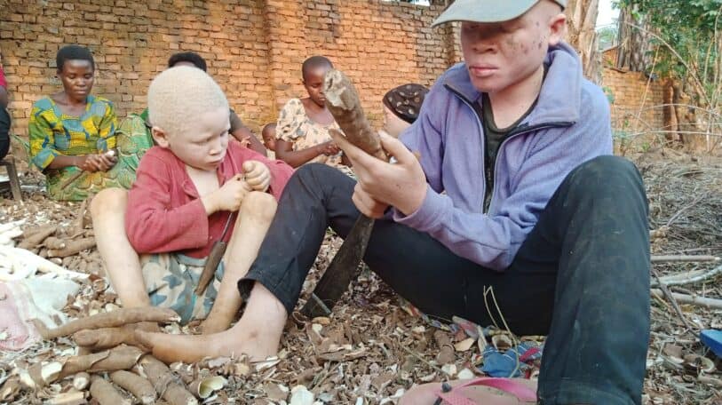 Rumonge : le combat d’une mère pour ses enfants albinos