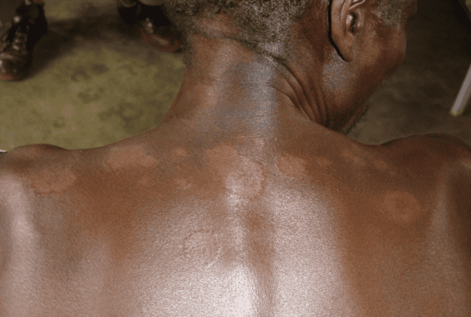 La lèpre : ce qu’il faut savoir sur cette maladie