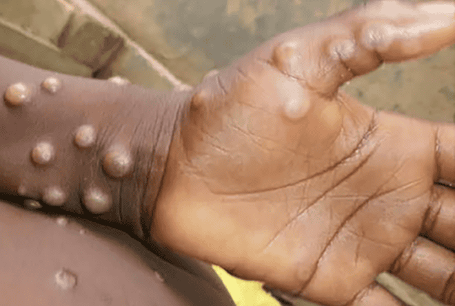 Variole du singe: parole de patients !